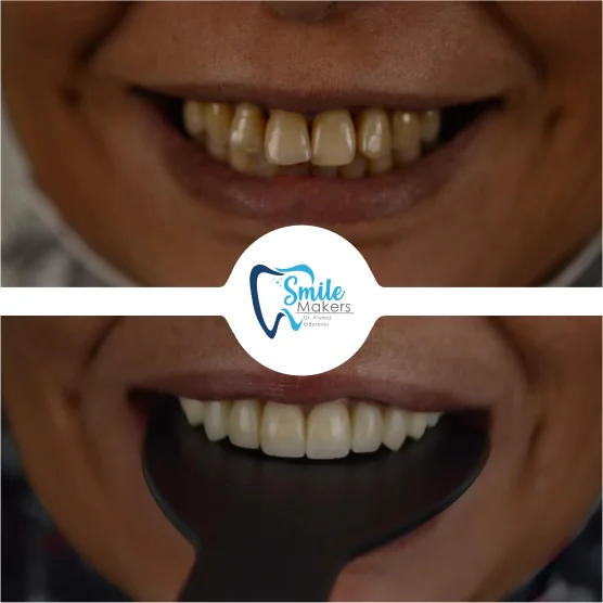 smile makers dental clinic patient before and after