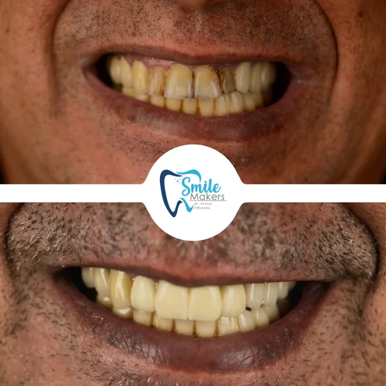 smile makers dental clinic patient before and after