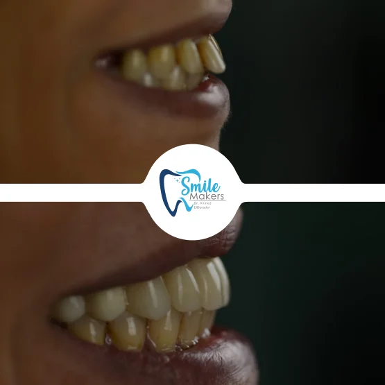 smile makers dental clinic patient before and after